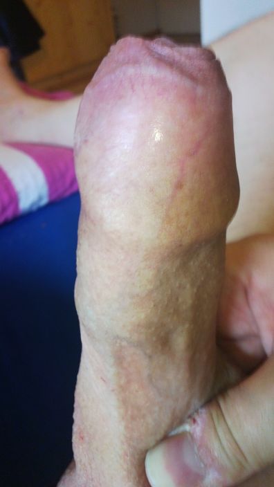 foreskin