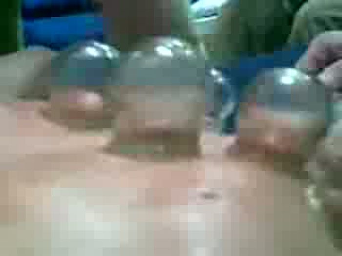 Парню ставят банки